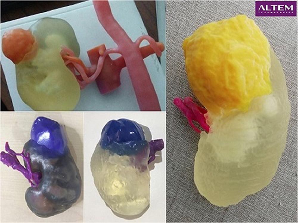 3D Printing Kidney saved